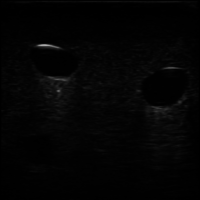 PICC II_2