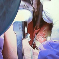 Simulatore di cuore battente per ECMO 2