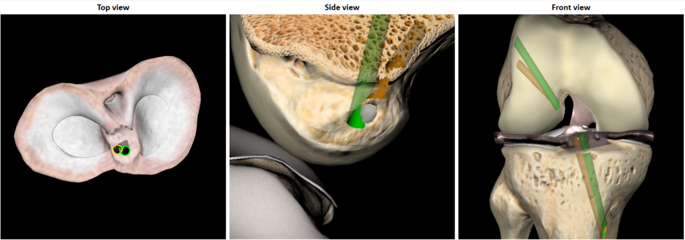 ArthroS_Knee_Arthroscopic_Simulator_ACL_Reconstruction_tunnel_placement