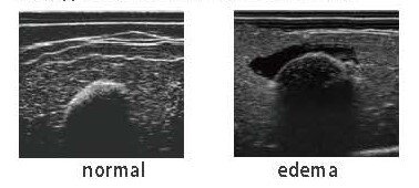 edema